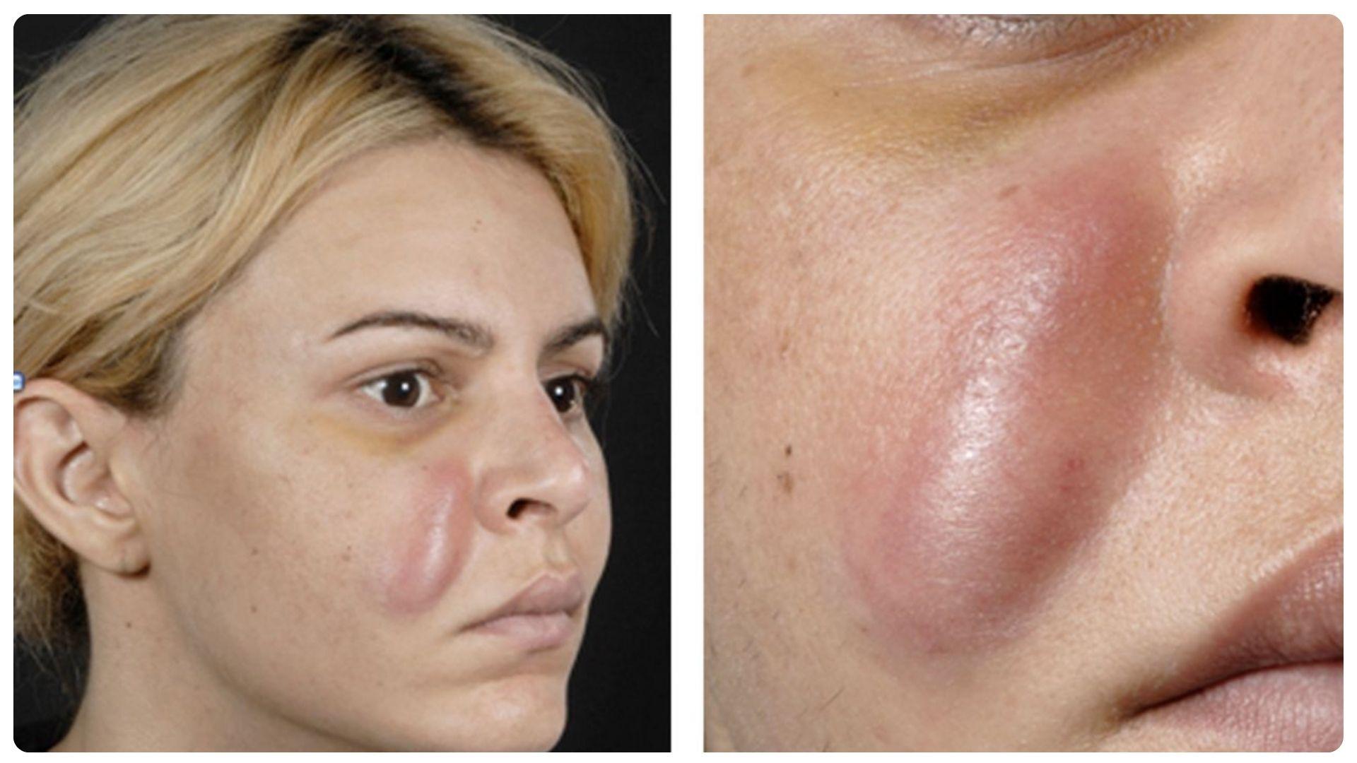 Tiêm filler có hại về sau không? 7 tác dụng phụ thường gặp 15 Nếu xuất hiện vón cục cần được xử lý kịp thời