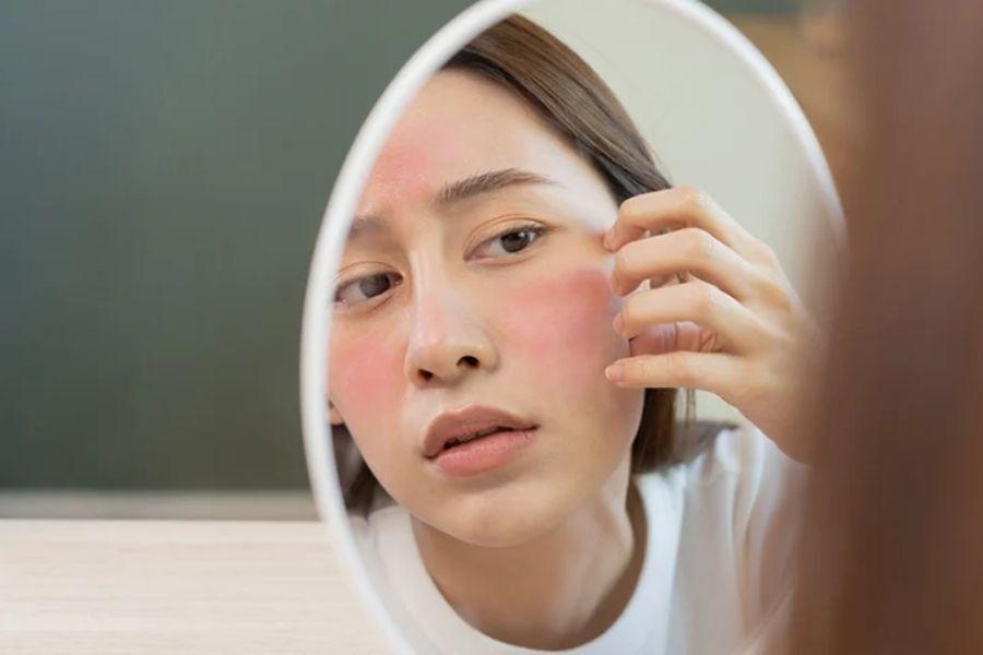 Tiêm filler má là gì? Những lưu ý nên biết khi thực hiện 8 Người có cơ địa quá nhạy cảm, tiền sử dị ứng với thành phần của filler nên cân nhắc trước khi tiêm