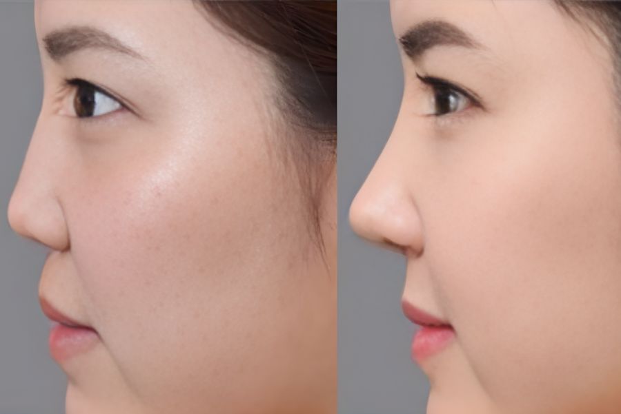 Nâng mũi sụn Surgiform và những ưu điểm nổi bật 7 Người có sống mũi thấp có thể áp dụng nâng mũi sụn Surgiform để cải thiện