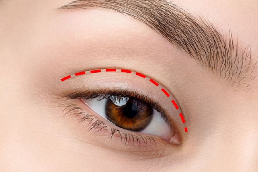 Nhấn mí có đau không? Những điều cần biết trước khi thực hiện 10 Nhấn mí giúp đôi mắt rõ nét hơn