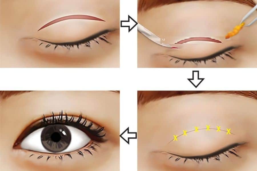 Nhấn mí có đau không? Những điều cần biết trước khi thực hiện 11 Nhấn mí mắt nhanh hồi phục