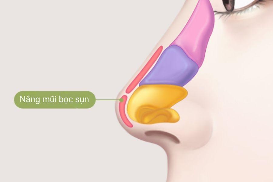 Nâng mũi bọc sụn là gì? Có những phương pháp nào 7 Phần sụn được đặt ở đầu mũi giúp hạn chế tình trạng lộ sóng, bóng đỏ