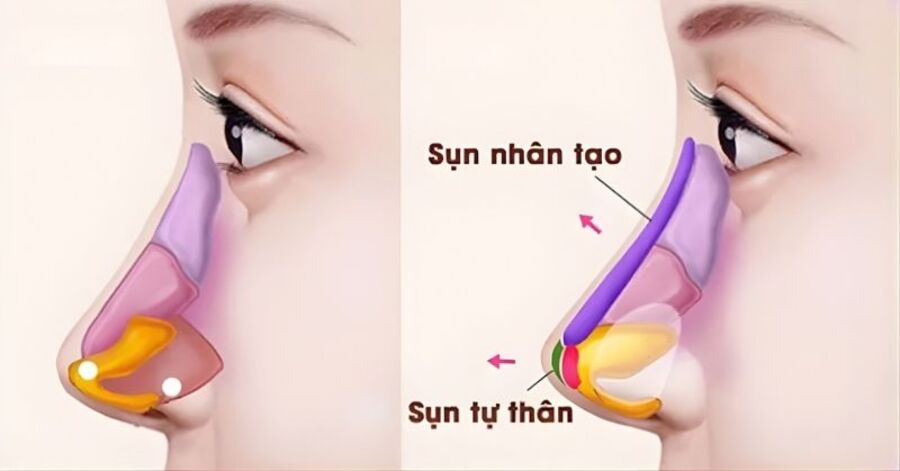 Phẫu thuật nâng mũi là gì? Các phương pháp phổ biến hiện nay 8 Phần sụn nhân tạo được đưa vào để định hình dáng mũi