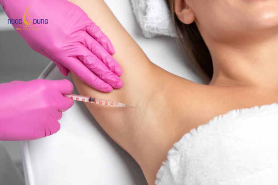 Tiêm botox trị hôi nách có hiệu quả? Đánh giá từ chuyên gia 12 Phương pháp tiêm botox trị hôi nách sử dụng đầu kim siêu nhỏ, không gây đau đớn, không cần nghỉ dưỡng sau khi thực hiện