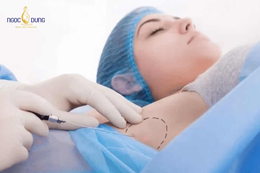 Tiêm botox trị hôi nách có hiệu quả? Đánh giá từ chuyên gia 13 Quy trình tiêm botox trị mồ hôi nách tại Ngọc Dung được thực hiện chuẩn y khoa