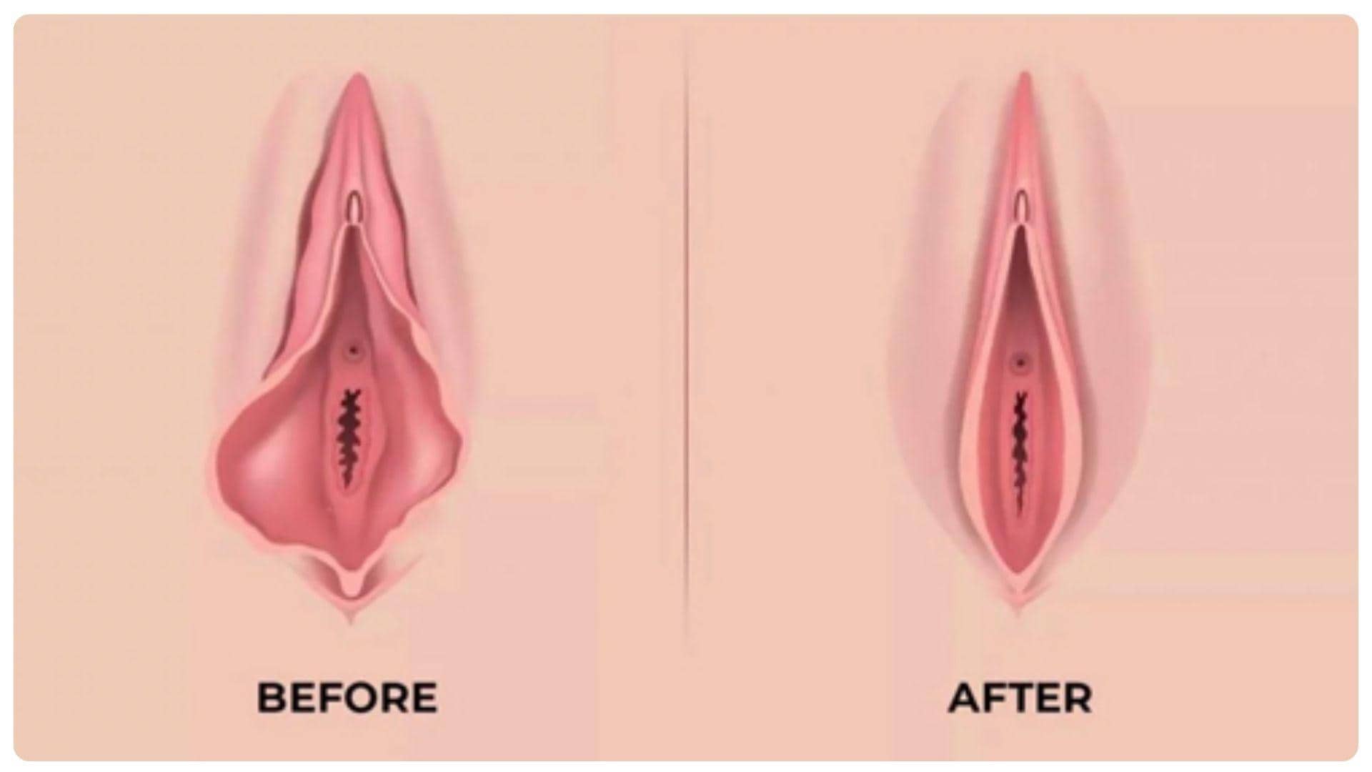 Cắt môi bé bao lâu thì lành? Quy trình hồi phục và chăm sóc 12 Sau 3 tháng hình dáng môi bé trở nên tự nhiên hơn