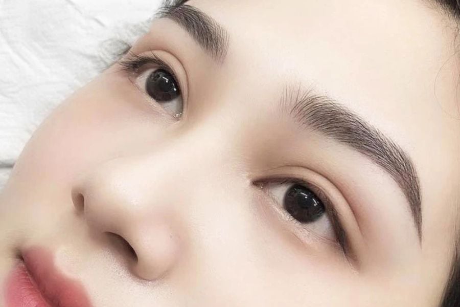 Nâng cung mày bao lâu thì hết sẹo? Yếu tố nào ảnh hưởng 10 Sau 6 tháng gần như không thấy sẹo nâng cung chân mày