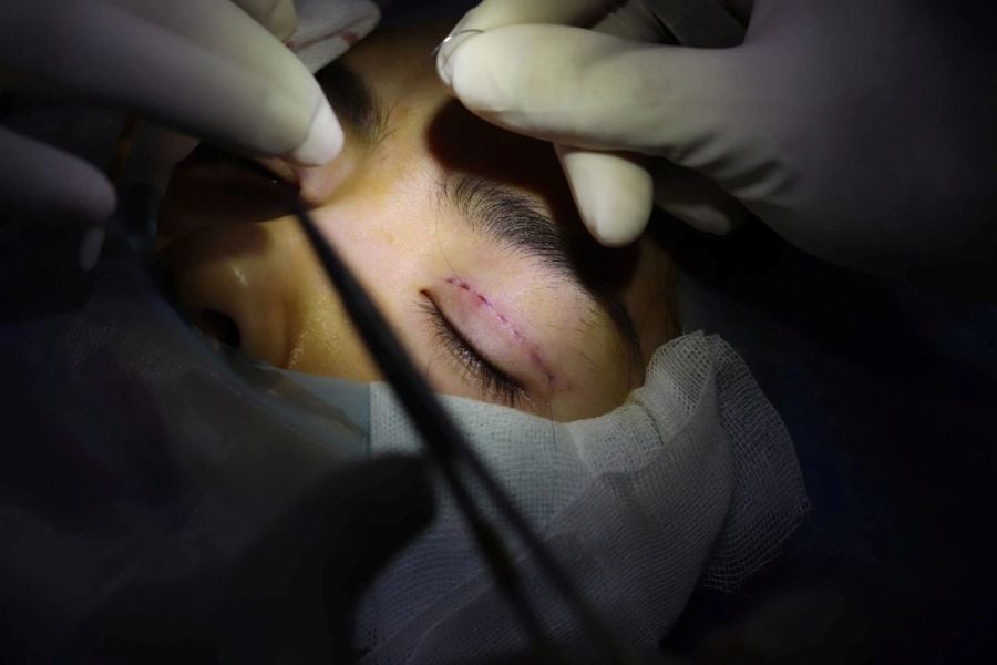 Nhấn mí có đau không? Những điều cần biết trước khi thực hiện 12 Tay nghề của Bác sĩ tác động nhiều đến độ đau khi nhấn mí