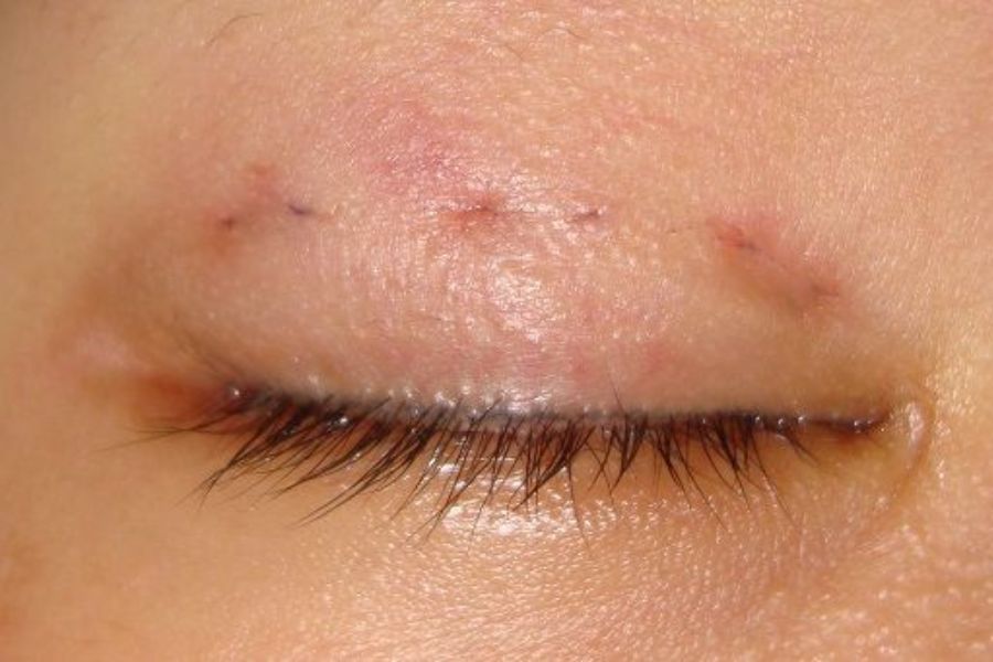 Nhấn mí có đau không? Những điều cần biết trước khi thực hiện 14 Thời gian hết đau tùy thuộc vào cơ địa mỗi người