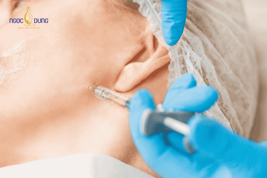 Tiêm botox gọn hàm - Kiến thức cần biết trước khi thực hiện 10 Thời gian thực hiện tiêm gọn hàm ngắn nhưng mang lại kết quả nhanh chóng