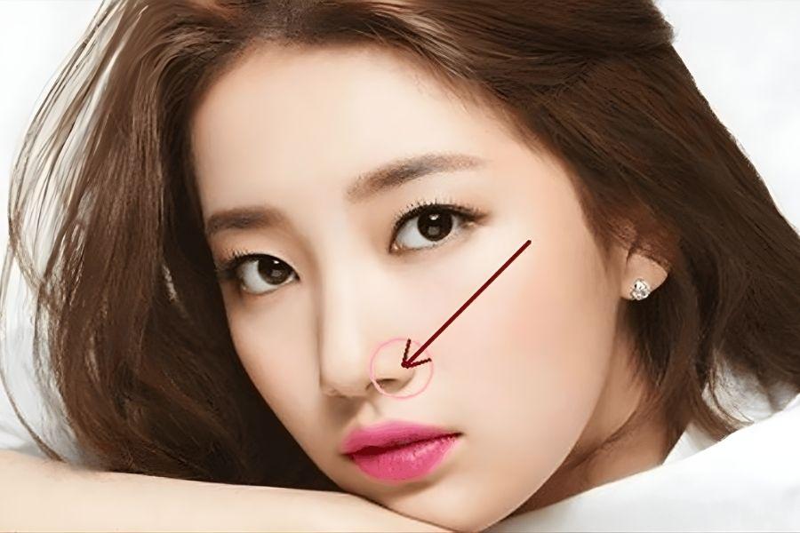 Phẫu thuật thu gọn cánh mũi giá bao nhiêu tiền? 5 Thu gọn cánh mũi giá bao nhiêu tiền phụ thuộc vào các yếu tố khác nhau