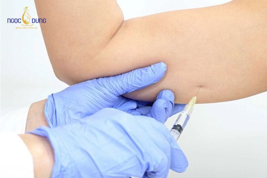 Tiêm botox thon gọn bắp tay - Những ai nên thực hiện 8 Tiêm botox thon gọn bắp tay