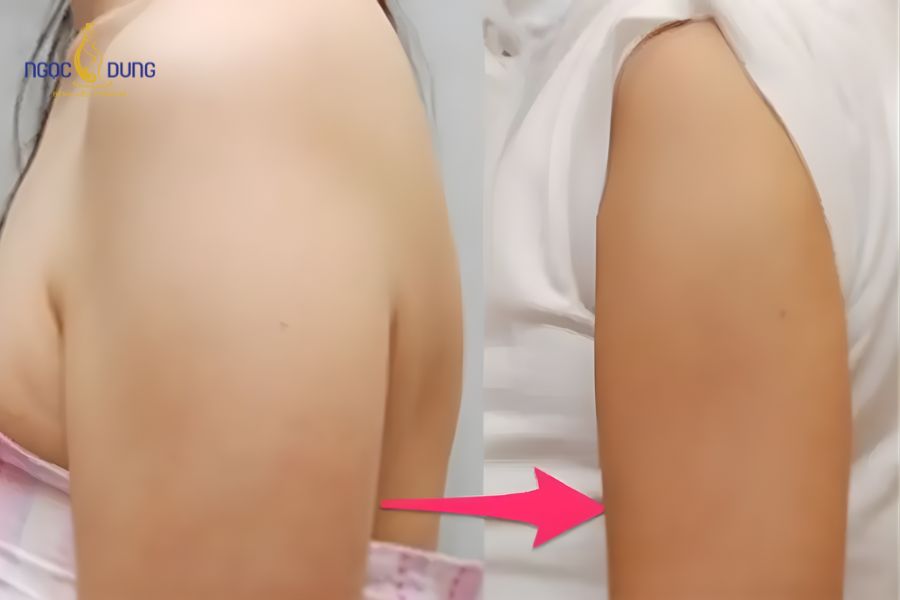 Tiêm botox thon gọn bắp tay - Những ai nên thực hiện 12 Tiêm botox thon gọn bắp tay là thủ thuật an toàn nếu được thực hiện đúng cách