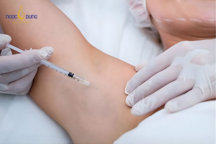 Tiêm botox trị hôi nách có hiệu quả? Đánh giá từ chuyên gia 9 Tiêm botox trị hôi nách giúp kiểm soát hiệu quả lượng mồ hôi tiết ra và ngăn chặn mùi hôi