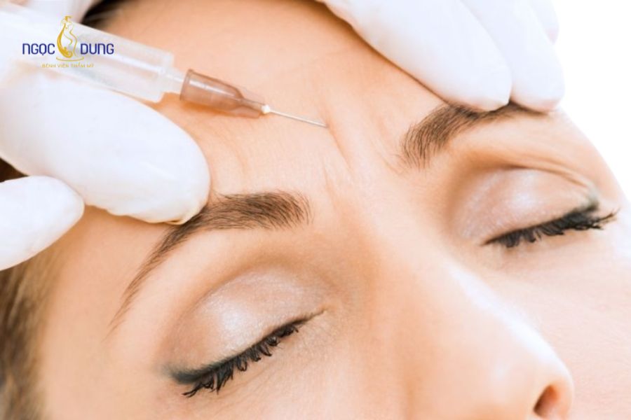 Tiêm botox xóa nhăn là gì? Ưu & nhược điểm và lưu ý cần biết 10 Tiêm botox xóa nhăn mang lại làn da căng mịn, trẻ trung nhanh chóng