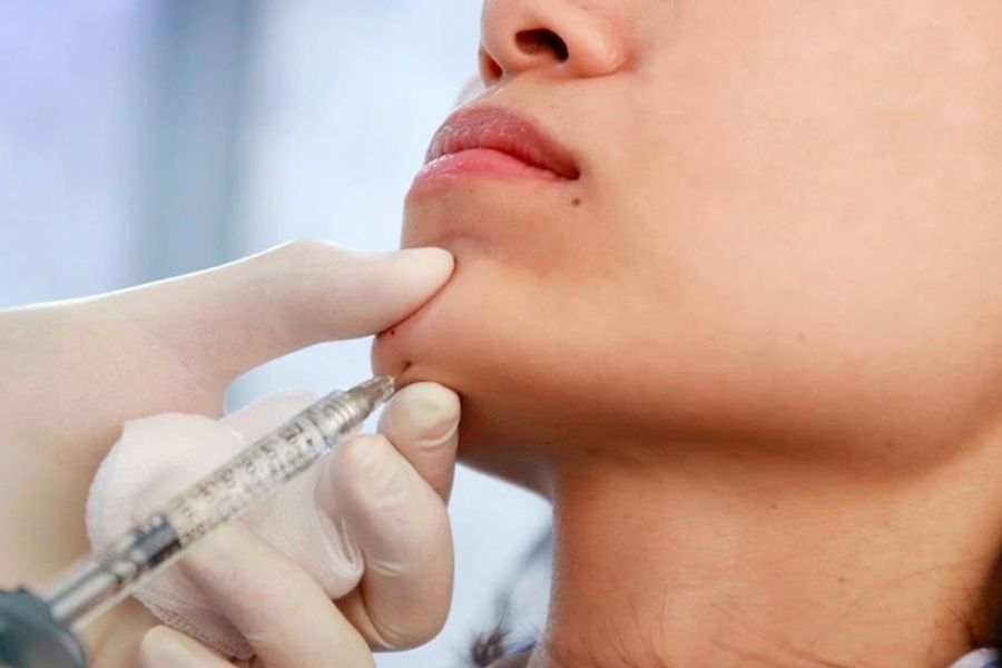Tiêm filler cằm bao lâu thì đẹp tự nhiên? Những yếu tố liên quan 10 Tiêm filler cằm bao lâu thì đẹp được rất nhiều người quan tâm
