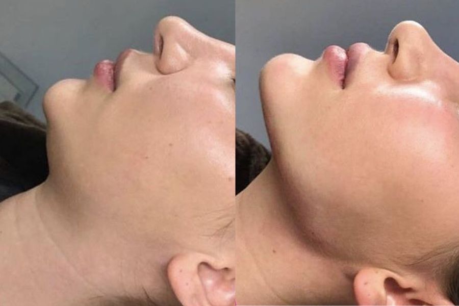 Tiêm filler cằm bao lâu thì đẹp tự nhiên? Những yếu tố liên quan 13 Tiêm filler cằm được nhiều người yêu thích nhờ nhanh chóng và hiệu quả