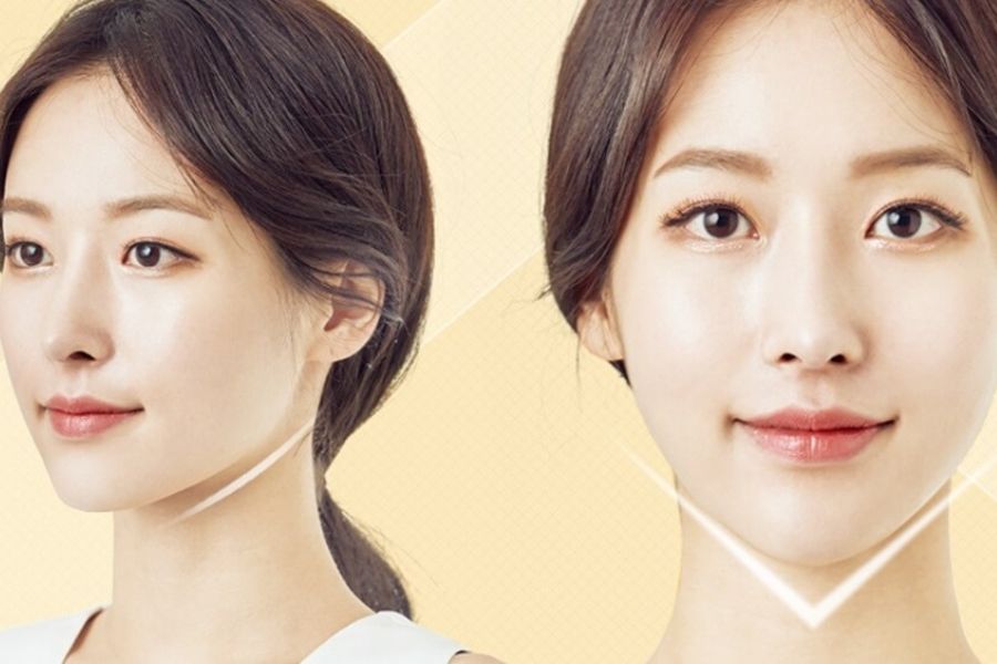 Tiêm filler cằm bao lâu thì đẹp tự nhiên? Những yếu tố liên quan 11 Tiêm filler giúp định hình dáng cằm đẹp hài hòa gương mặt
