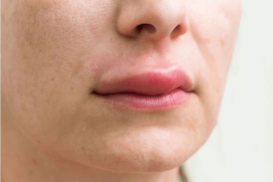 Tiêm filler bao lâu thì hết sưng? Cách giảm sưng an toàn 11 Tiêm filler môi thường sưng lâu hơn những vùng khác