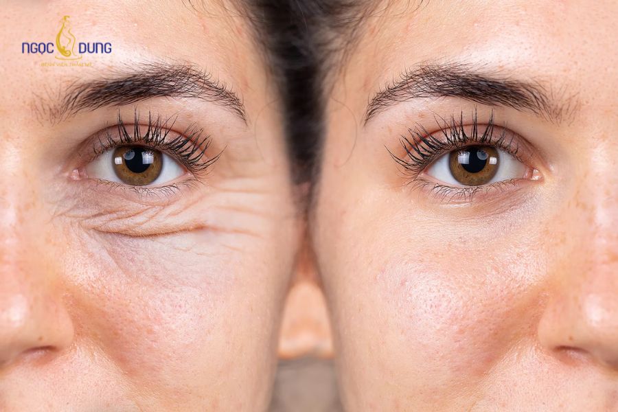 Tiêm botox xóa nhăn là gì? Ưu & nhược điểm và lưu ý cần biết 13 Tiêm xoá nhăn mắt giúp đôi mắt trông trẻ trung, rạng rỡ hơn