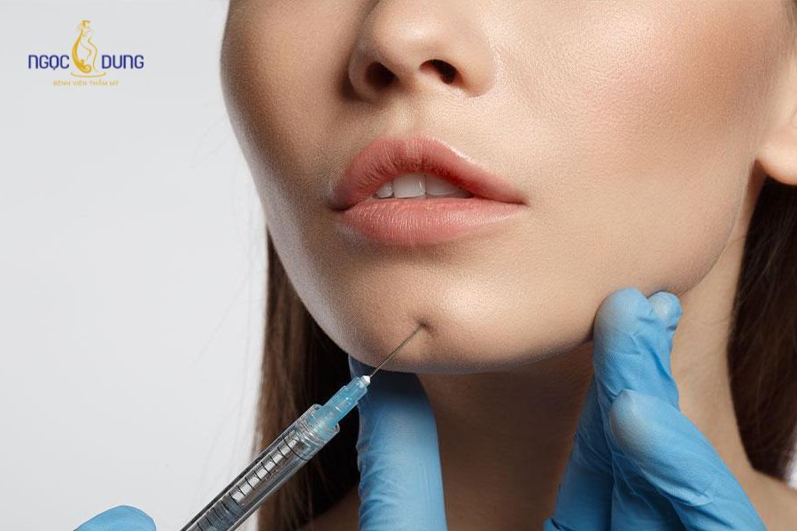 Tiêm filler cằm là gì? Những lưu ý để có dáng cằm tự nhiên 7 Tiêm filler cằm
