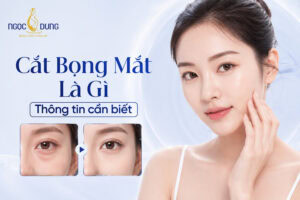 Phẫu thuật cắt bọng mắt