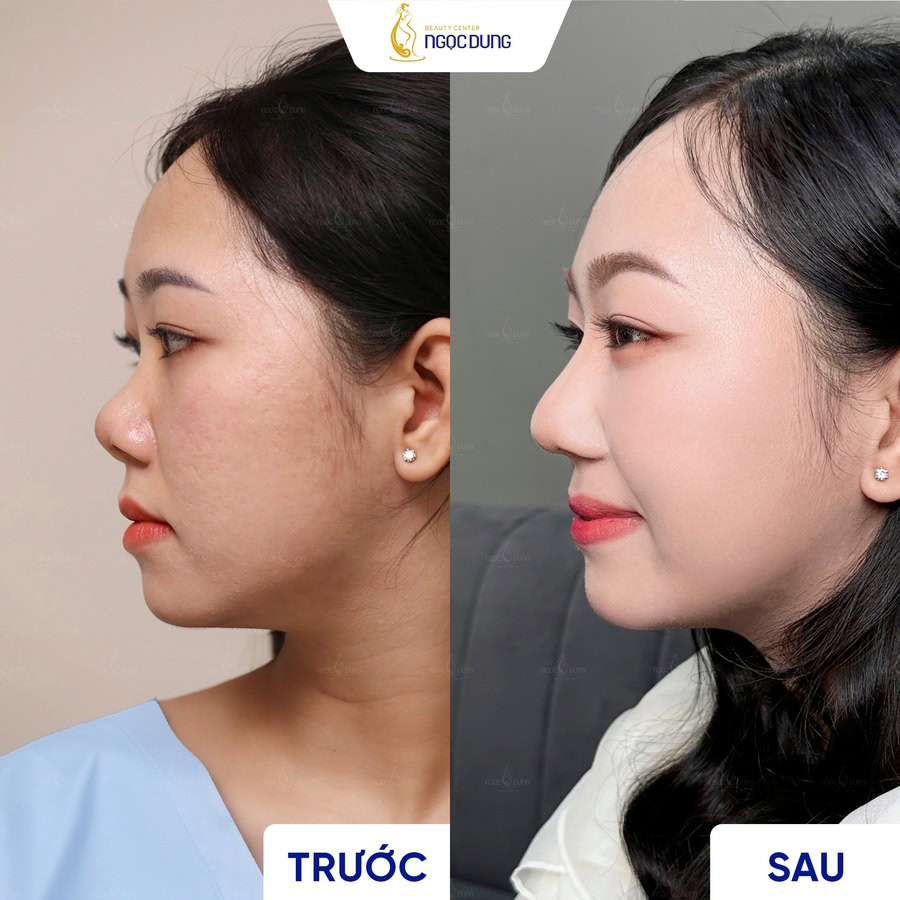 KH truoc sau nang mui 2