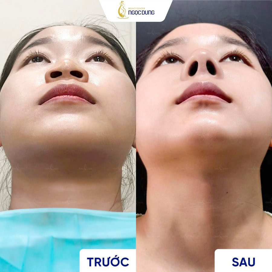 KH truoc sau nang mui