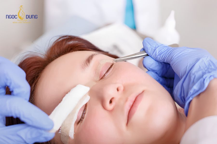 Mỡ mí mắt trên là gì? Cách giảm mỡ ở mí mắt trên hiệu quả 11 Áp dụng các phương pháp thẩm mỹ là cách làm giảm mỡ mí mắt trên nhanh chóng nhất