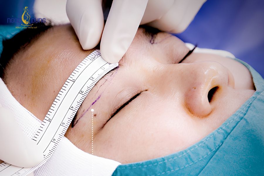 Bác sĩ đo vẽ xác định vùng da chùng cần loại bỏ ở bờ trên hoặc bờ dưới cung lông mày