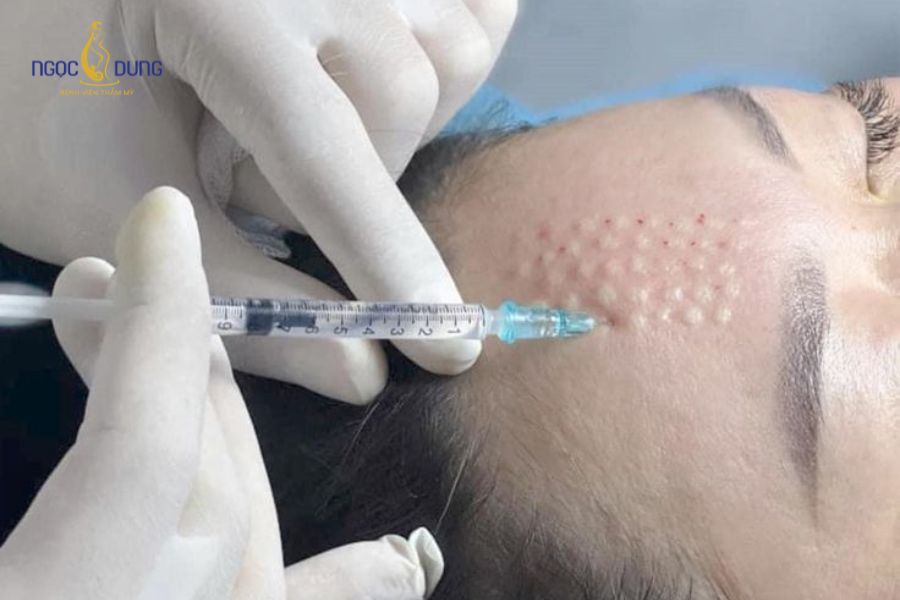 Bầu có tiêm meso được không là thắc mắc của nhiều chị em