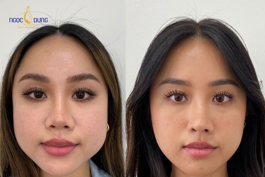 Tác hại của tiêm botox gọn hàm và những lưu ý cần biết 9 Botox gọn hàm không gây hại nếu thực hiện tại cơ sở uy tín