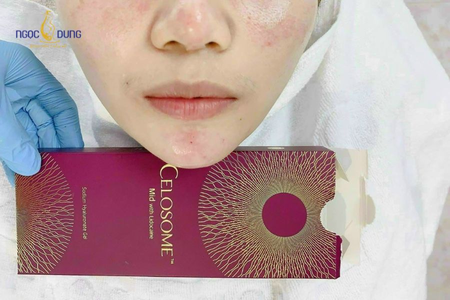 Các loại filler Hàn Quốc được ưa chuộng nhất 2026 21 Celosome là dòng filler Hàn Quốc được sản xuất bởi ExoCoBio Inc.