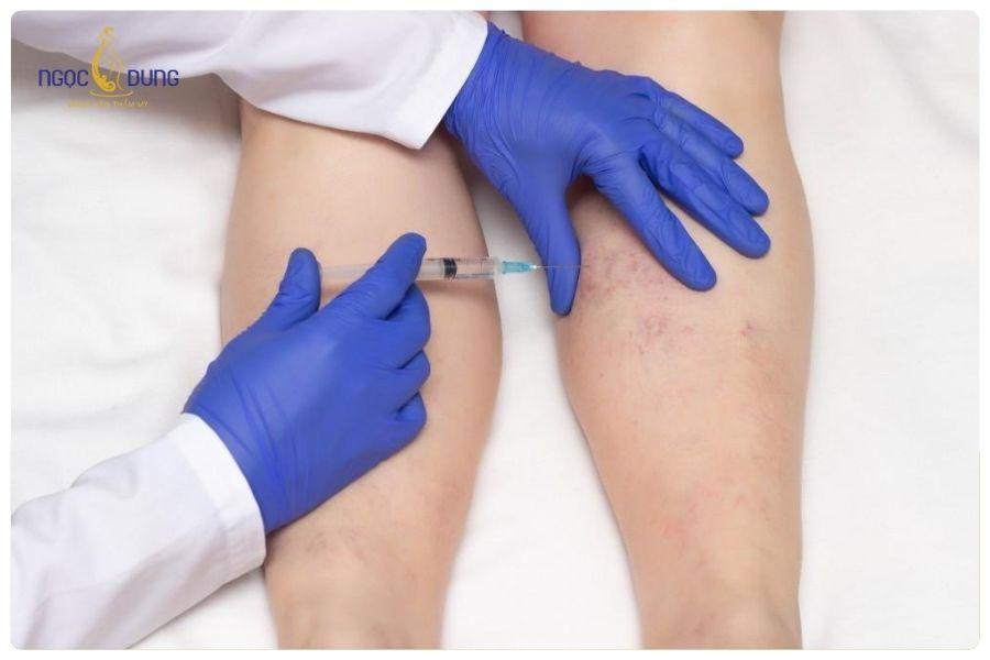 Lợi ích của tiêm botox thon gọn bắp chân? Lưu ý khi tiêm? 22 Chăm sóc đúng cách giúp Botox ổn định tốt và duy trì hiệu quả lâu hơn