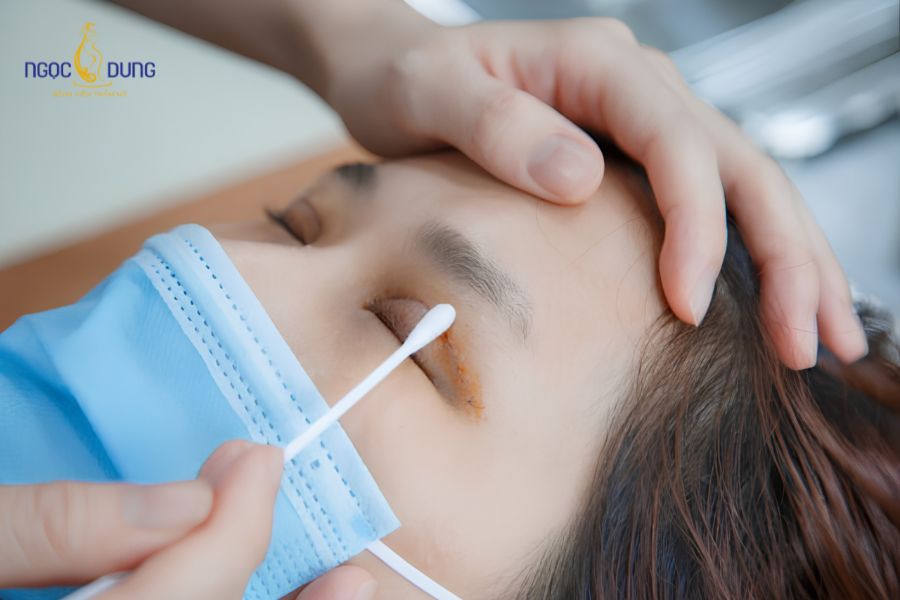 Nhấn mí bằng chỉ là gì? Có nên nhấn mí bằng chỉ không? 9 Chăm sóc hậu phẫu và vệ sinh nút bấm mí đúng cách quyết định độ bền đẹp của nếp mí