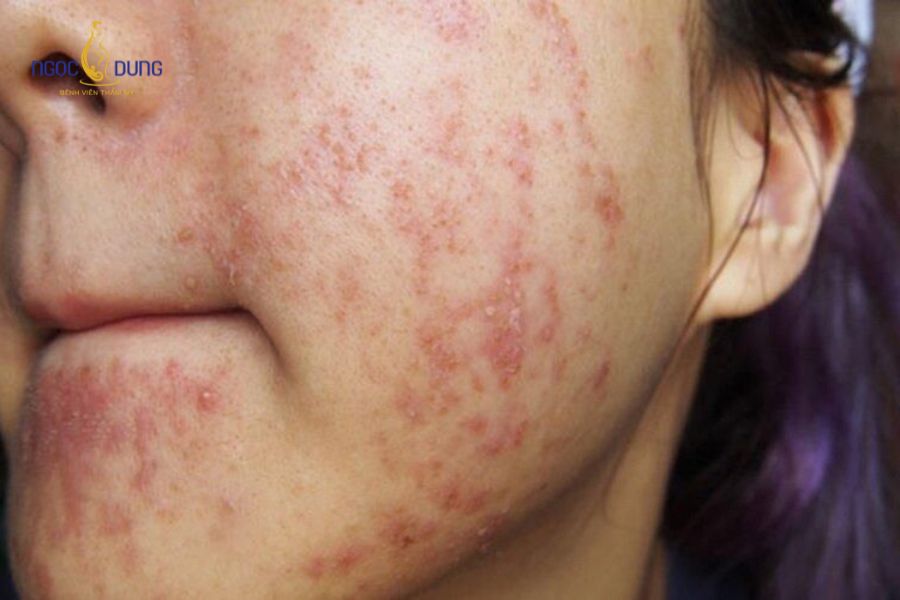 Mẹ bầu tiêm meso được không? Có ảnh hưởng gì đến thai nhi không? 12 Da thường nhạy cảm hơn trong thời kỳ mang thai