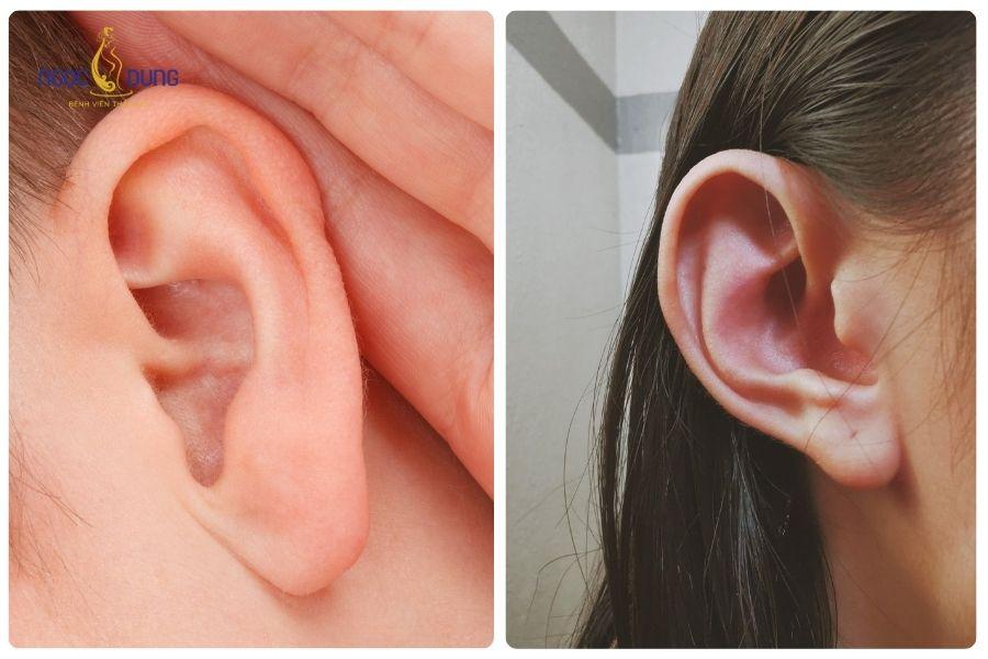 Tiêm filler tai tài lộc có an toàn không? Những điều bạn cần biết 13 Dái tai đầy đặn trong nhân tướng học Á Đông thường tượng trưng cho tài lộc và may mắn