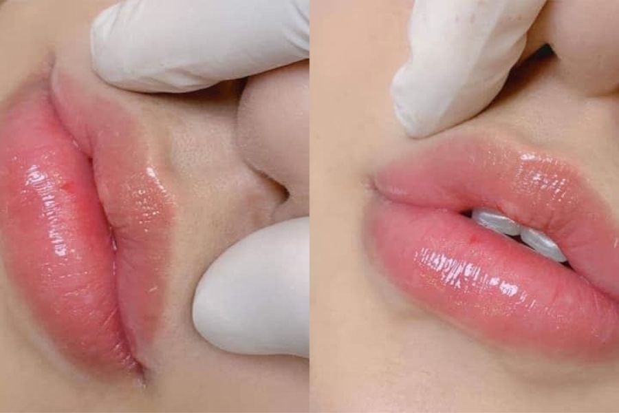 TOP 10+ dáng môi tiêm filler đẹp tự nhiên và HOT TREND hiện nay 14 Dáng môi căng mọng tự nhiên giúp đôi môi quyến rũ