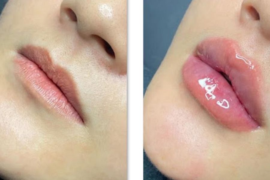 TOP 10+ dáng môi tiêm filler đẹp tự nhiên và HOT TREND hiện nay 15 Dáng môi tều dành cho những người thích phong cách quyến rũ
