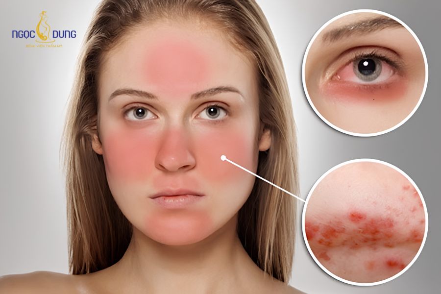 Bọng mắt bị sưng đỏ và đau là do đâu? Có nguy hiểm không? 10 Dị ứng mỹ phẩm cũng có thể là nguyên nhân khiến bọng mắt bị sưng