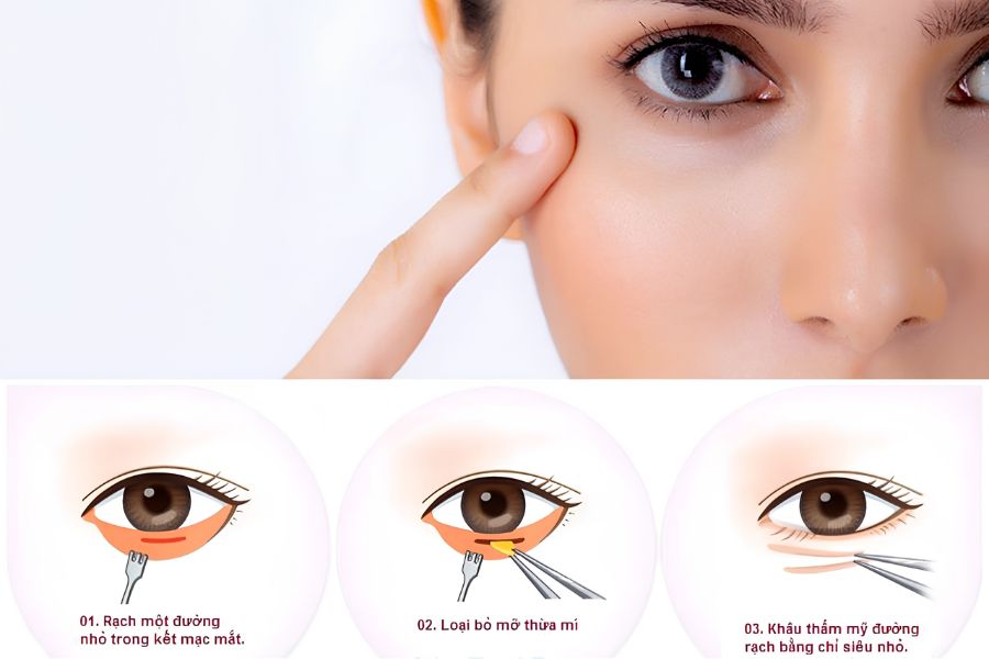Cắt bọng mỡ mắt dưới bao nhiêu tiền? Yếu tố ảnh hưởng đến giá 8 Đường rạch sát viền mi dưới cho phép bác sĩ vừa bóc tách mỡ thừa vừa xử lý triệt để phần da chùng do lão hóa