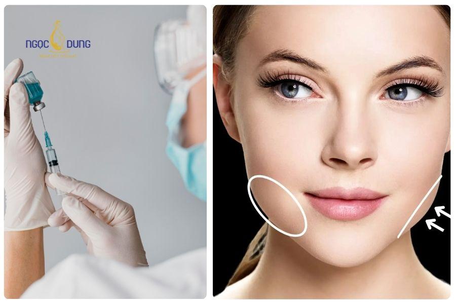 Tiêm tan filler bao lâu thì tiêm lại được? Bao lâu thì tan hết 18 Filler lệch dáng sau tiêm có thể cải thiện bằng tiêm tan filler