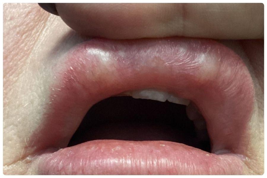 Giải đáp về tiêm tan filler: Phân loại, các dấu hiệu và lưu ý 12 Filler vón cục, lồi lõm là dấu hiệu cần cân nhắc tiêm tan sớm để tránh ảnh hưởng thẩm mỹ