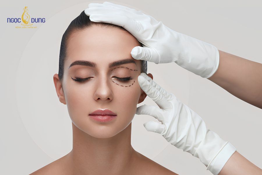 Phẫu thuật cắt mỡ mí mắt trên là gì? Cách chăm sóc sau thực hiện 6 Giải phóng da chùng và mỡ thừa giúp mắt mở to tự nhiên, cải thiện tầm nhìn, hạn chế nếp nhăn vùng trán