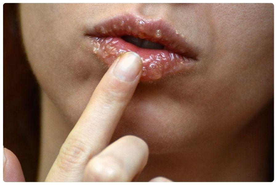 Tiêm filler môi bao lâu thì mềm? Bí quyết giúp môi vào form nhanh 13 Hạn chế tác động mạnh lên môi giúp filler ổn định và giữ form tốt hơn