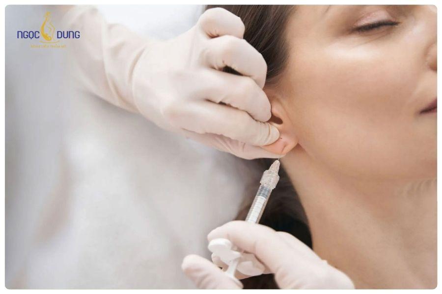 Tiêm filler tai tài lộc có an toàn không? Những điều bạn cần biết 17 Hiệu quả tiêm filler tai thường duy trì khoảng 6–12 tháng tùy cơ địa