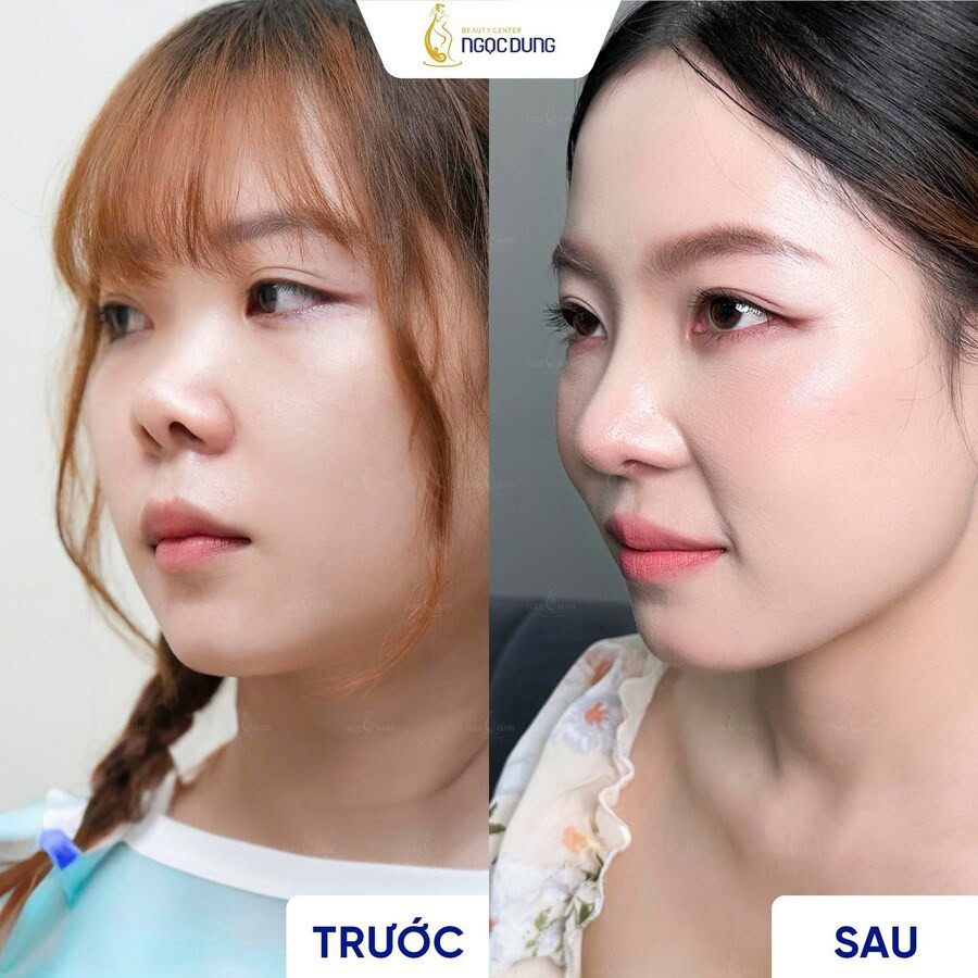 Phẫu thuật nâng mũi: Tổng quan, chỉ định và quy trình thực hiện 12 Hình ảnh trước và sau phẫu thuật nâng mũi tại Bệnh Viện Thẩm Mỹ Ngọc Dung, mang lại sự thay đổi rõ rệt và hài hòa với đường nét gương mặt