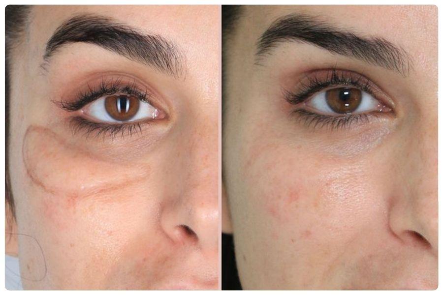 Giải đáp về tiêm tan filler: Phân loại, các dấu hiệu và lưu ý 11 Hyaluronidase giúp phân giải filler HA nhanh chóng, đưa vùng tiêm về trạng thái tự nhiên