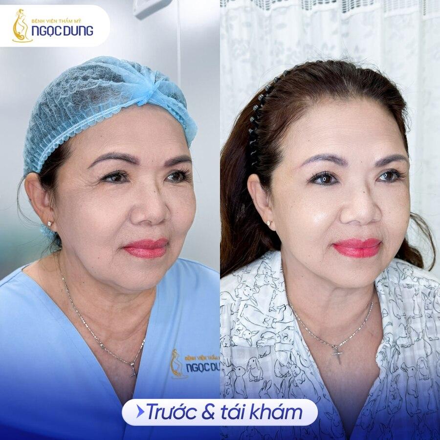 Thẩm mỹ treo chân mày giá bao nhiêu? Bảng giá mới nhất 5 Kết quả thực hiện treo chân mày tại BVTM Ngọc Dung