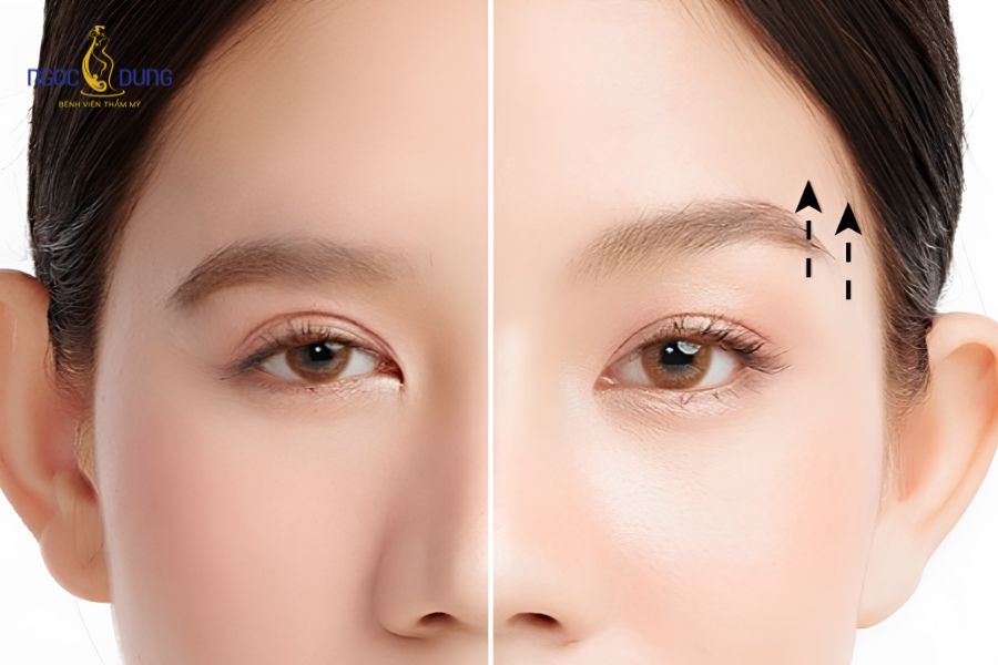 Nên cắt mí hay treo cung chân mày để đôi mắt trẻ hơn? 4 Khách hàng có sẵn nếp mí rõ nét nhưng bị sạt trễ cung mày thích hợp với phương pháp treo chân mày